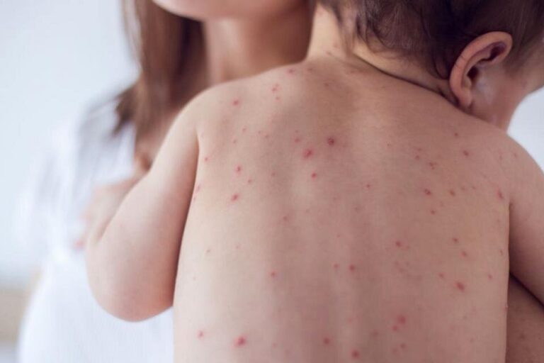 Sarampión en Argentina: crecen los casos y llaman a vacunar a los niños