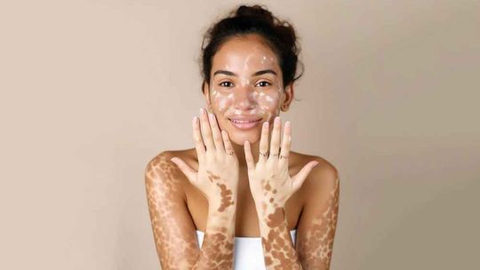 Día mundial del vitiligo: causas, impacto emocional y la necesidad de mayor visibilidad